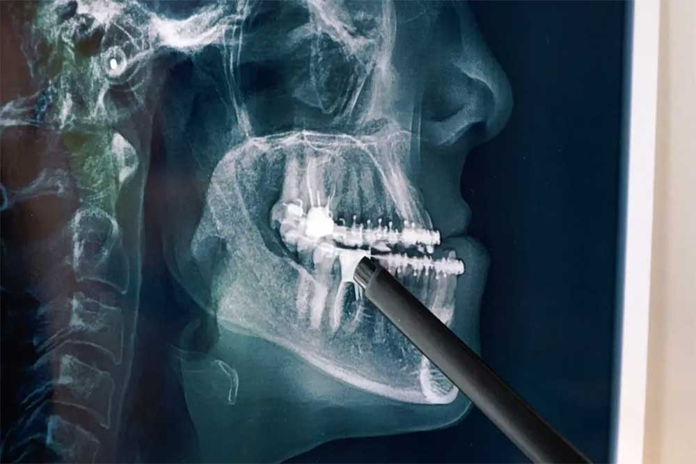 إزالة الأسنان المخفية مثل ضرس العقل أو إزالة الجذر، وهو أمر لا يمكن تحقيقه إلا بالجراحة مع خبرة الدكتور عماد زاده، ستشعر بالراحة
