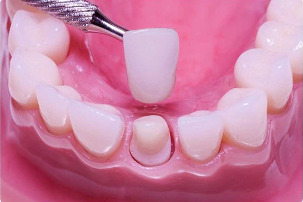 يتم استخدام أجزاء الأسنان التي يمكن لصقها باللثة لتعويض الأسنان المفقودة في عيادة الدكتور عماد زاده.