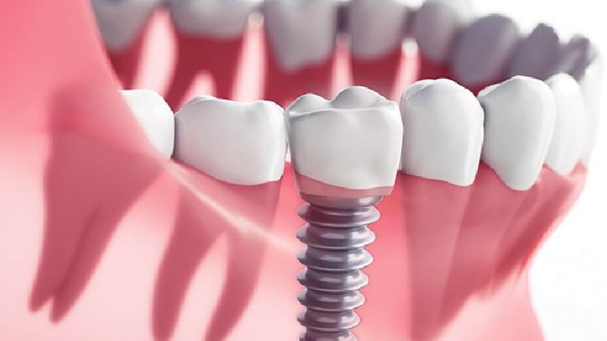 ایمپلنت از روش‌های مدرن برای جایگزینی دندان‌های از بین رفته است. که کلیه خدمات آن با کیفیت بالا در مطب دکتر محمد رضا عمادزاده انجام میشود.