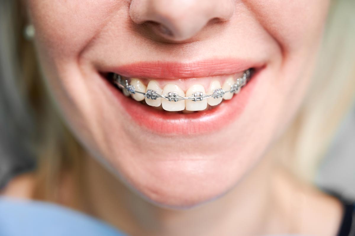 دندانهای-خود-را-با-ارتودنسی-در-مطب-دکتر-عمادزاده-به-شکل-بی-نظیری-اصلاح-کنید